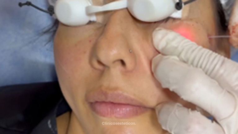 Endolift - Dr. Miguel Ángel Cortés