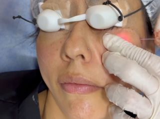 Endolift - Dr. Miguel Ángel Cortés