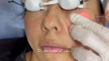 Endolift - Dr. Miguel Ángel Cortés