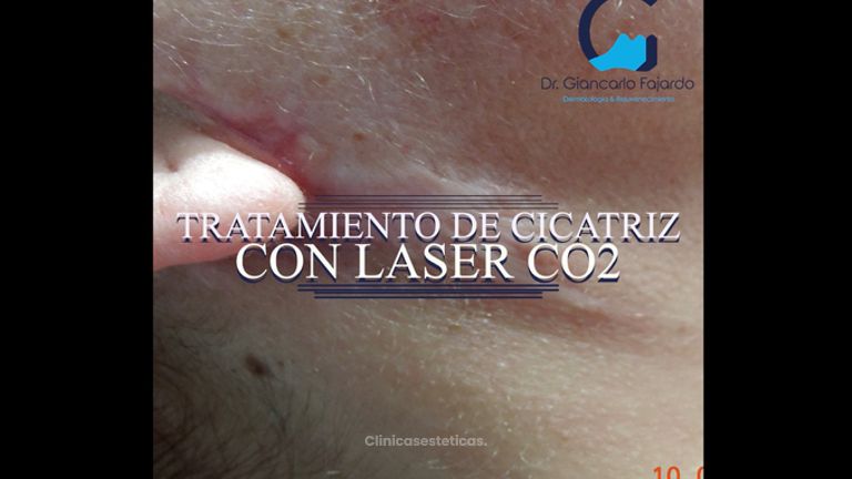 Cicatrices - Dr. Giancarlo Fajardo