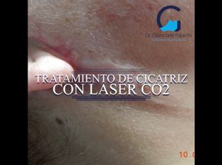 Cicatrices - Dr. Giancarlo Fajardo
