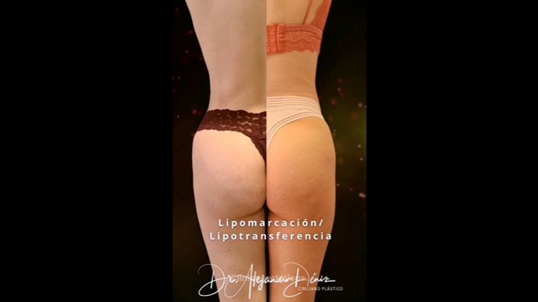Lipotransferencia - Dr. Alejandro Deniz Martínez