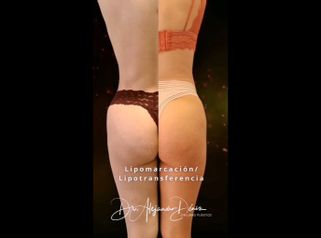 Lipotransferencia - Dr. Alejandro Deniz Martínez