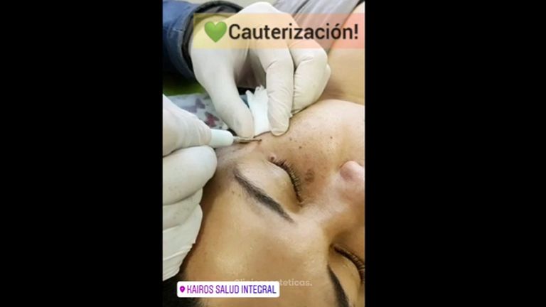 Cauterización - Kairos Salud Integral