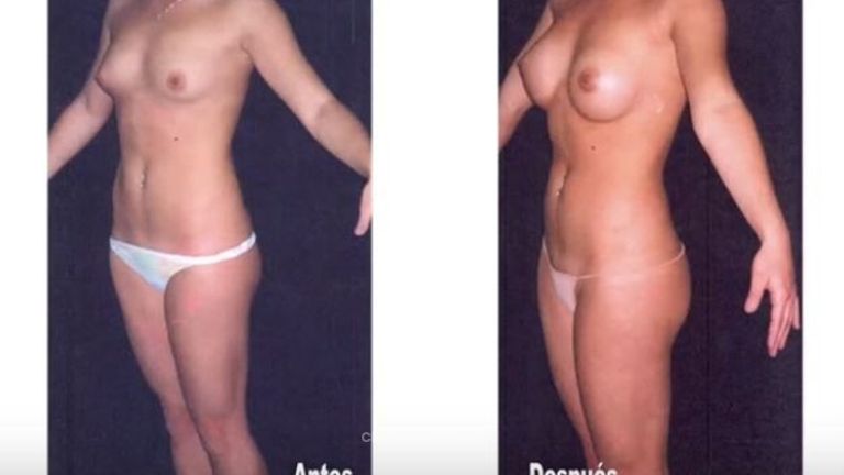 Cirugia de Senos con resultados naturales con seguimiento especial al paciente Mamoplastia Colombia