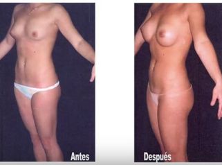 Cirugia de Senos con resultados naturales con seguimiento especial al paciente Mamoplastia Colombia