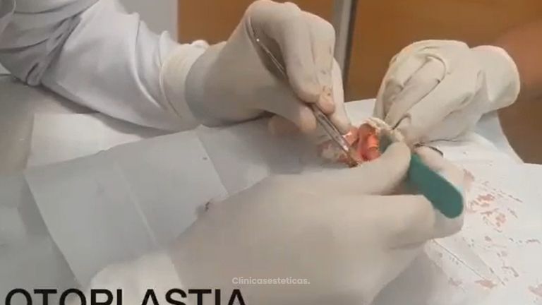 Otoplastia