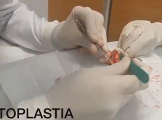 Otoplastia