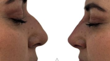 Rinomodelación  - Dra. Yulieth Figueroa Peñaranda