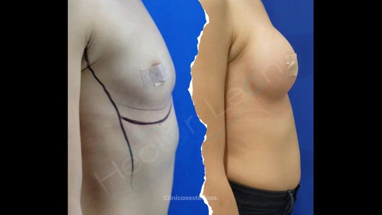 Mamoplastia de aumento  - Dr. Héctor Guillermo León Higuera