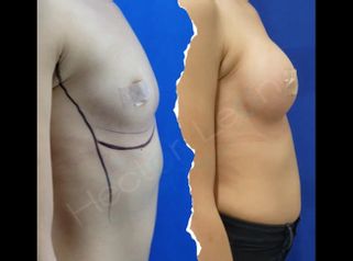 Mamoplastia de aumento  - Dr. Héctor Guillermo León Higuera