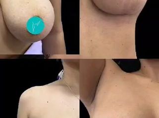 Mastopexia - Dra. Ángeles Esmeral