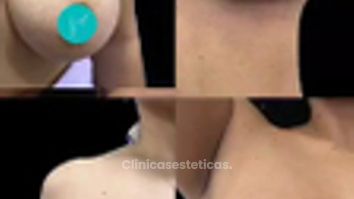 Mastopexia - Dra. Ángeles Esmeral