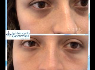 Blefaroplastia