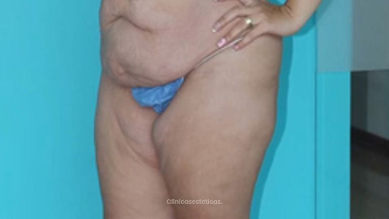 Liposucción - Dr. Milton Horacio Rincón Carranza