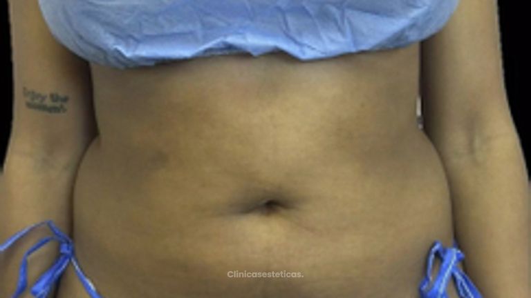 Liposucción - Dra. Ángeles Esmeral