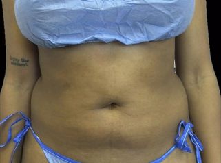 Liposucción - Dra. Ángeles Esmeral