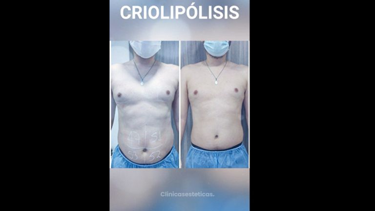 Criolipólisis - Kairos Salud Integral