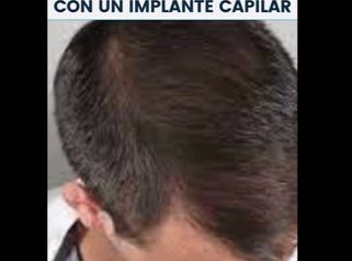 Implantes de Cabello