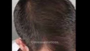 Implantes de Cabello