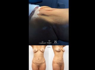 Abdominoplastia - Dr. Luis Fernando Reyes