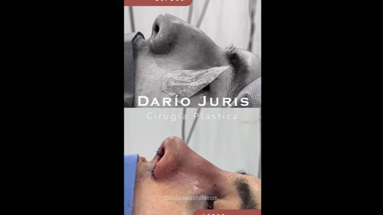 Rinoplastia - Dr. Darío Jurís