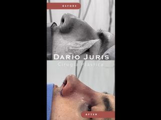 Rinoplastia - Dr. Darío Jurís