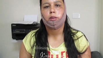 Testimonio lipomoldeamiento láser de papada + bichectomía