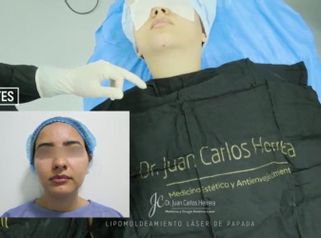 Liposucción de papada - Dr. Juan Carlos Herrera P.