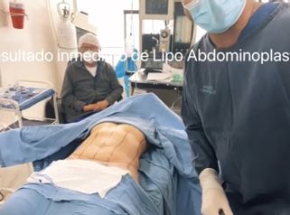 Lipoabdominoplastia - Dr. Jarold Effer Taylor