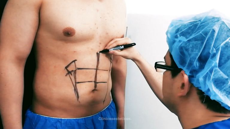 Lipoescultura masculina - Dr. Johnatan L De Guevara