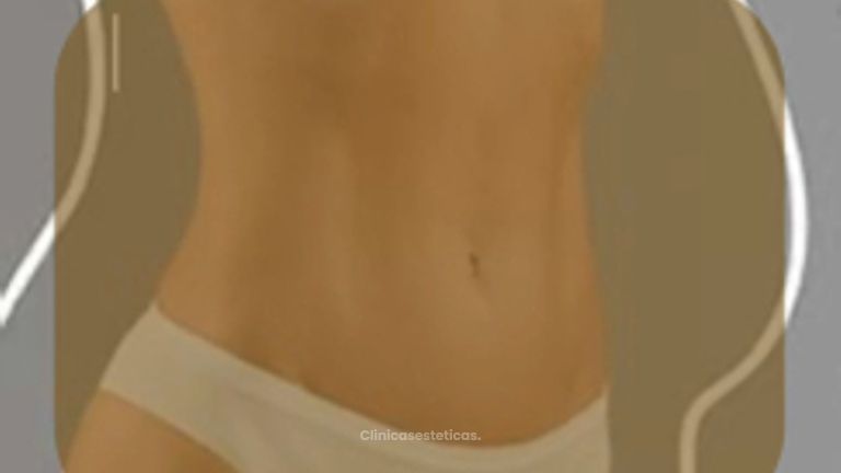 Liposucción - Dra. Nicole Echeverry