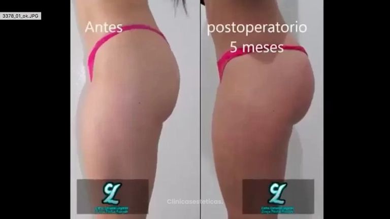 Aumento de glúteos con implantes - entrevista con paciente