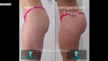 Aumento de glúteos con implantes - entrevista con paciente