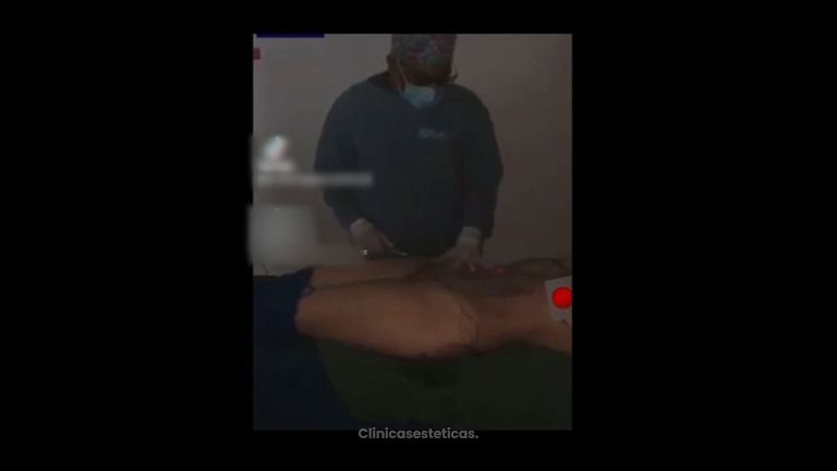 Liposucción - Dr. Victor Hugo Quevedo