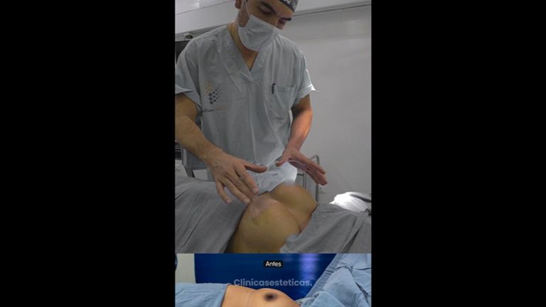 Mamoplastia de aumento - Dr. Luis Fernando Reyes