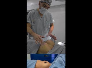 Mamoplastia de aumento - Dr. Luis Fernando Reyes