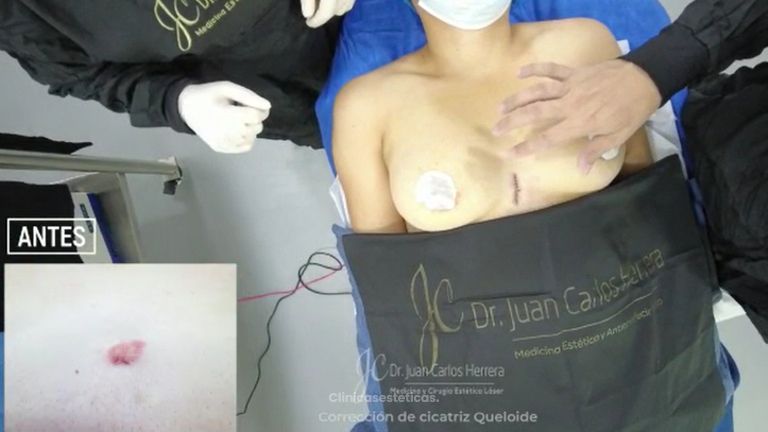 Cicatrices - Dr. Juan Carlos Herrera P.