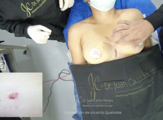 Cicatrices - Dr. Juan Carlos Herrera P.