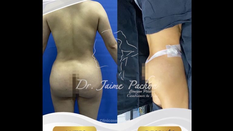Gluteoplastia - Dr. Jaime Pachón