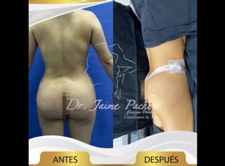 Gluteoplastia - Dr. Jaime Pachón