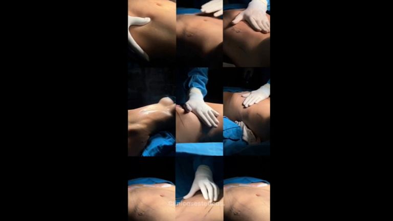Liposucción - Dr Fulvio Alexander Correa