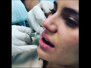 Perfilamiento de labios con Ácido Hialurónico