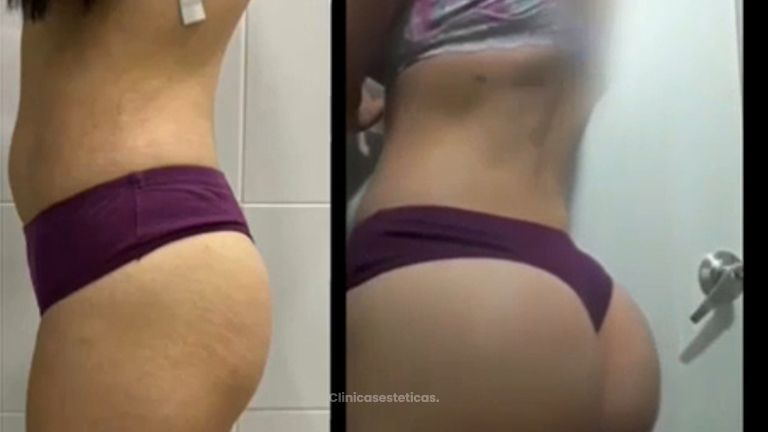 Antes y después Gluteoplastia