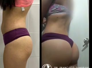 Antes y después Gluteoplastia