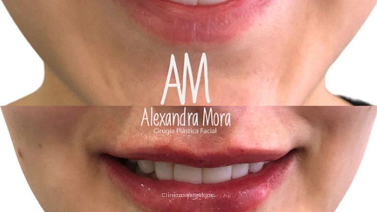 Relleno de Labios - Doctora Alexandra Mora