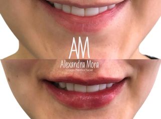 Relleno de Labios - Doctora Alexandra Mora