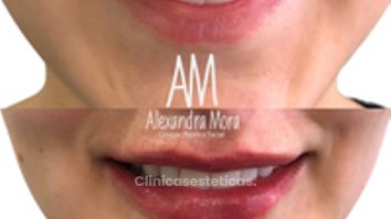 Relleno de Labios - Doctora Alexandra Mora