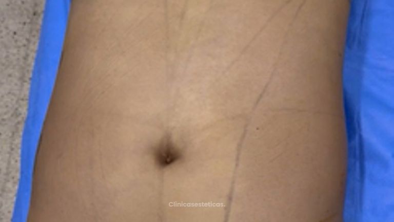 Lipólisis HD - Dr. Tobias Gutiérrez