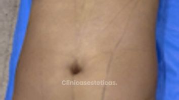 Lipólisis HD - Dr. Tobias Gutiérrez